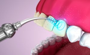 ультразвуковая чистка зубов в Подольске