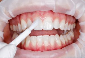 фторирование зубов по доступной цене